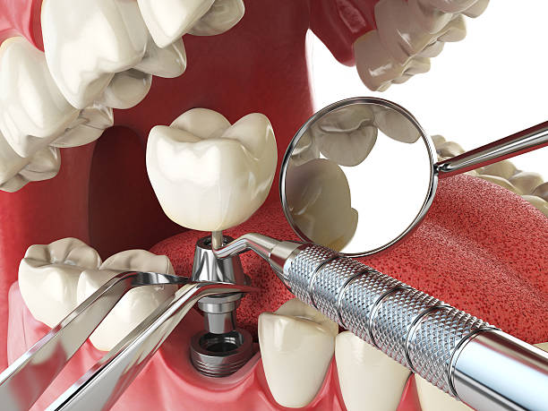 Best Emergency Dentist for Lost Fillings or Crowns in Moores Mill, AL
